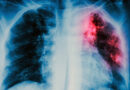 Crecen los casos de tuberculosis en Chaco y Salud reforzó el protocolo de prevención en las escuelas