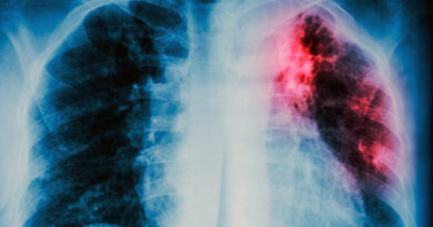 Crecen los casos de tuberculosis en Chaco y Salud reforzó el protocolo de prevención en las escuelas