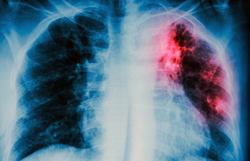 Crecen los casos de tuberculosis en Chaco y Salud reforzó el protocolo de prevención en las escuelas