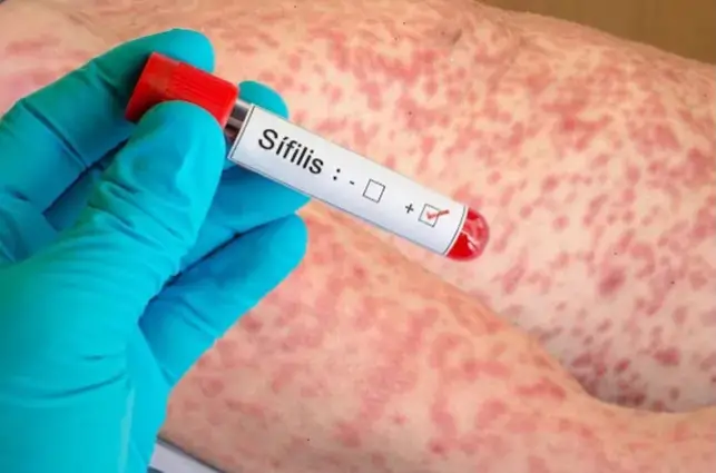 La sífilis se multiplicó por siete en Chaco: la alerta sanitaria apunta a los jóvenes